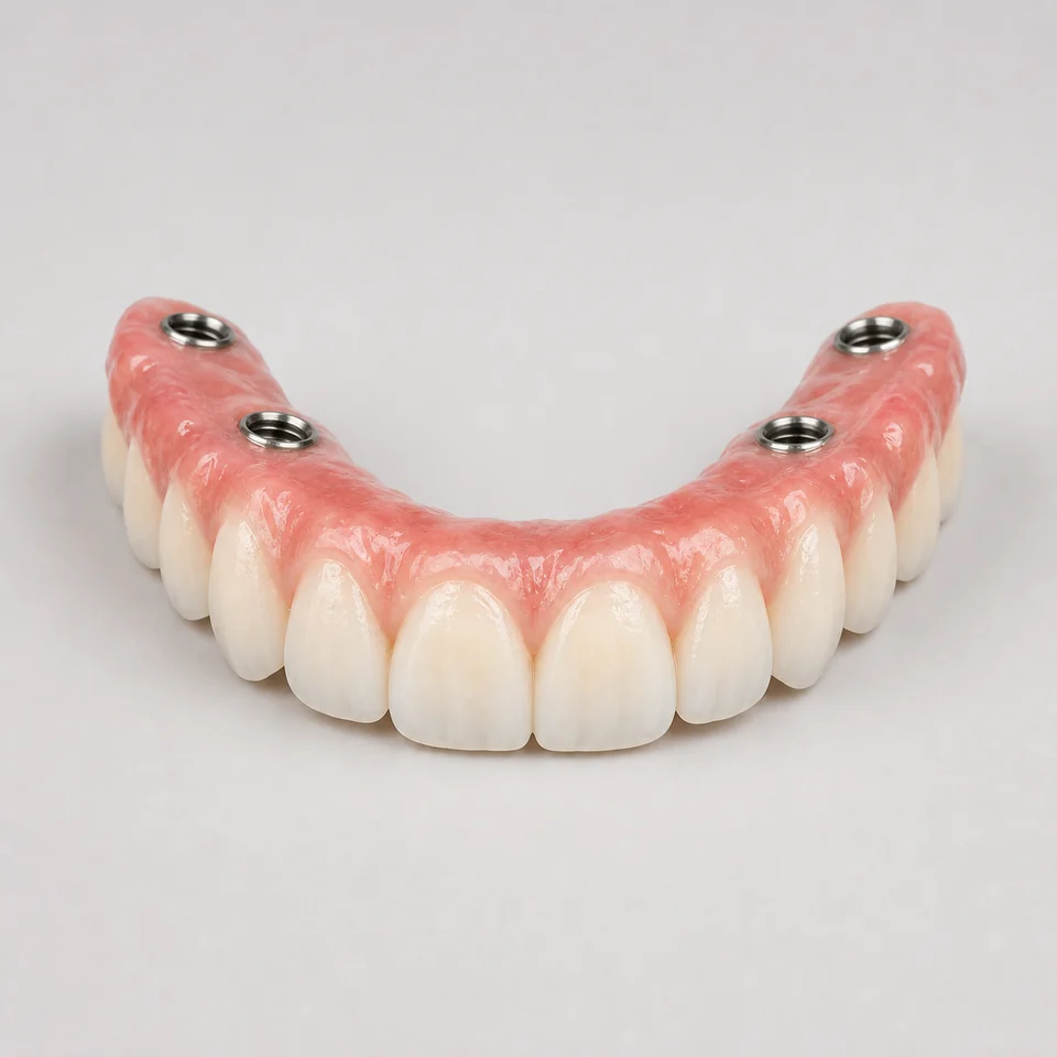 Full-arch All-on-X implant prosthesis with four titanium interfaces.